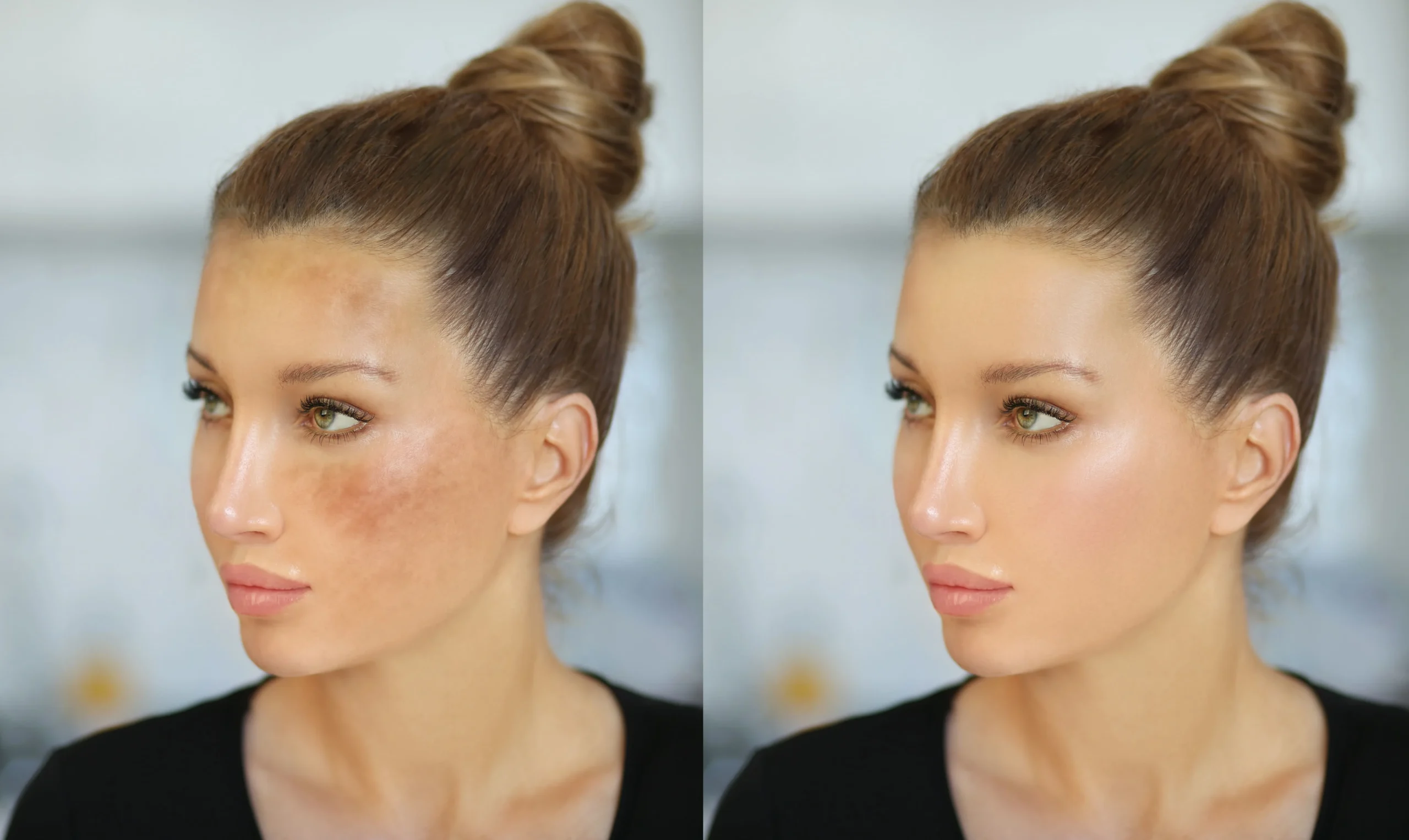 Condition Melasma Image 1 scaled