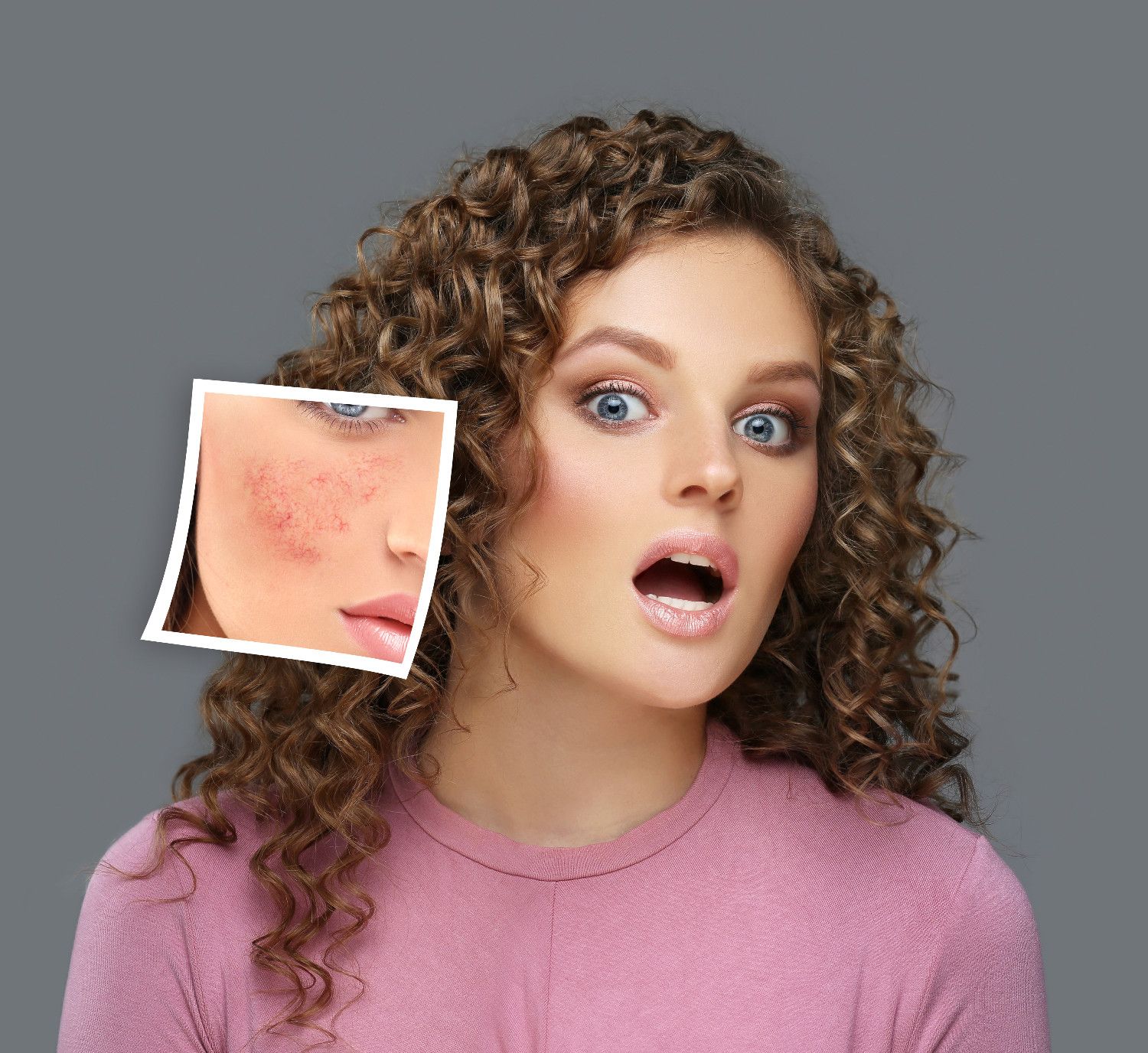 ConditionRosaceaImage